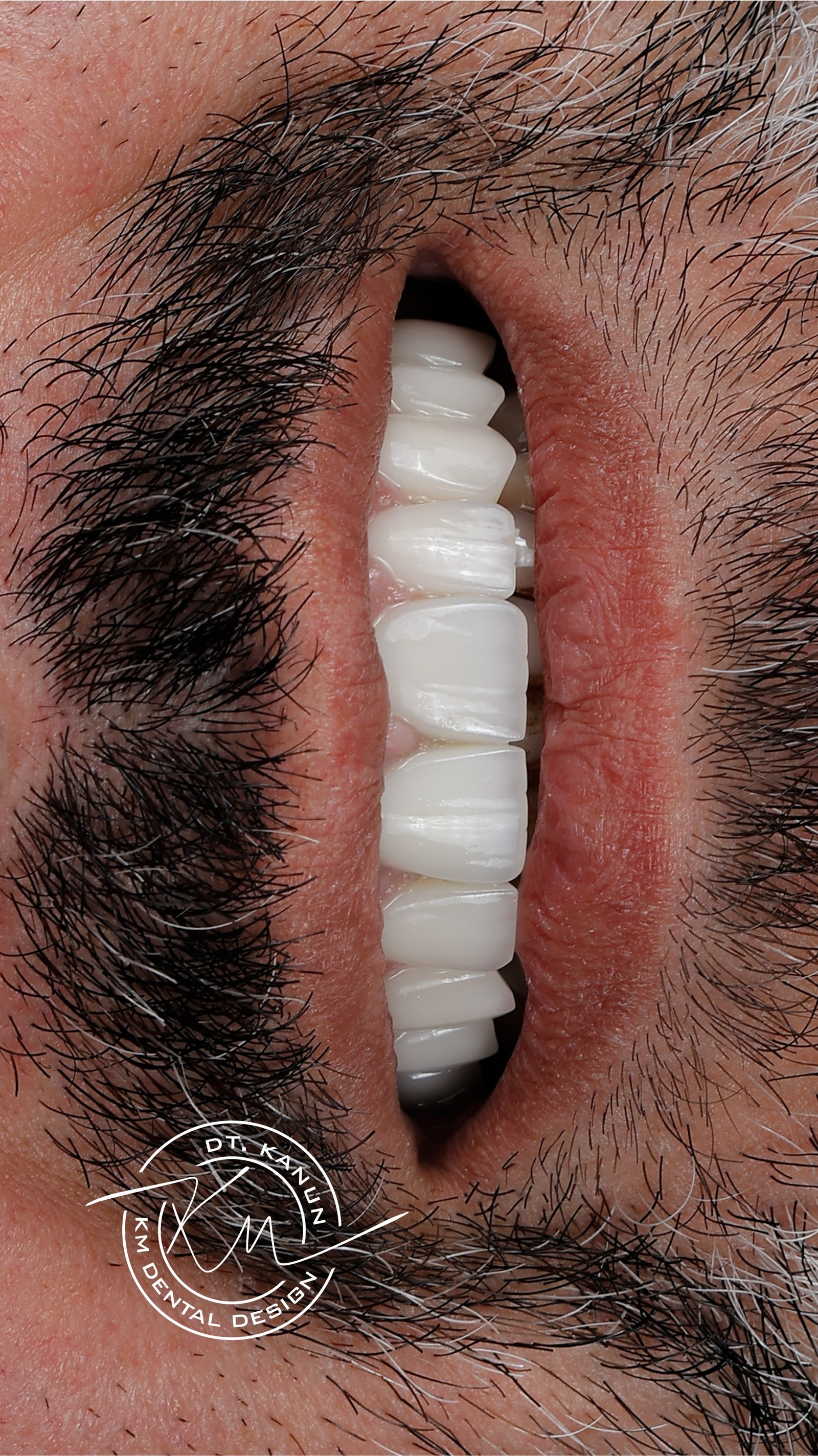 KM Dental Design - Before After 8